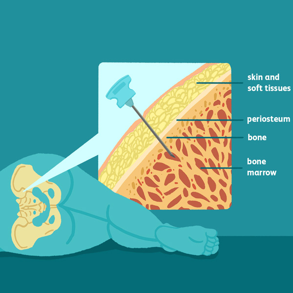 Bone Marrow Transplant